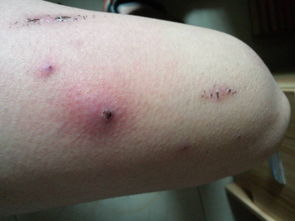 梦到腿上长了个大疖子，梦见身上的疖子出脓了