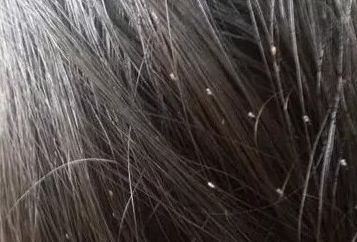 梦到头发上长虱子什么预兆，梦到头发长虱子了