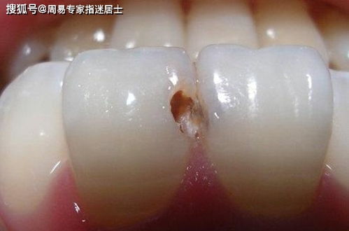 梦到掉很多牙齿没出血周公解梦，梦到掉很多牙齿是什么预兆不疼不出血