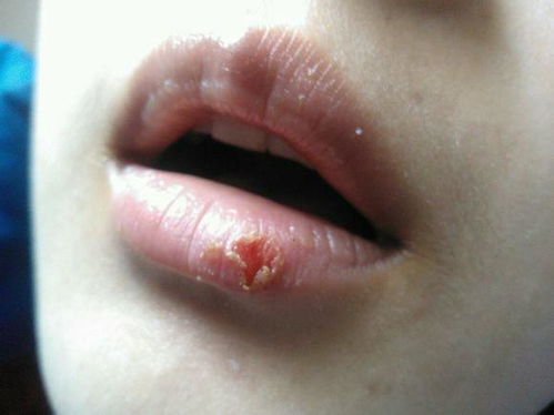 梦见嘴唇长水泡,梦见嘴上起泡了