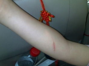 梦见手臂出血又止住了，梦见手臂出血是什么预兆解梦