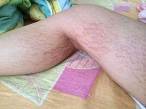 梦见妊娠纹红色，做梦长妊娠纹