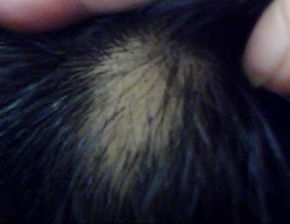 梦到自己头皮掉了一块什么意思，梦到自己头皮掉了一大块头皮屑