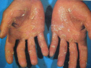 梦见自己双手水泡，梦到自己双手起满了泡