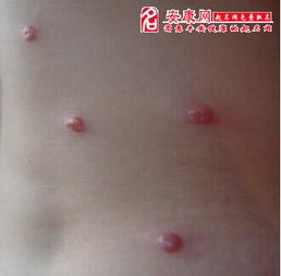 梦到自己手上长水泡了，梦到手上长水泡并破了出血