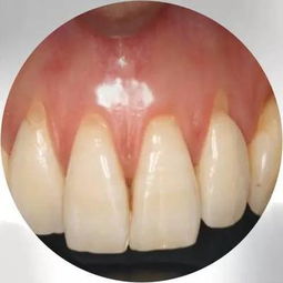 梦见重叠牙掉了，做梦梦到牙齿全掉了又长出来了重复