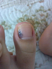 梦见大母脚趾甲盖掉了预示什么，梦见脚大母指甲盖掉了