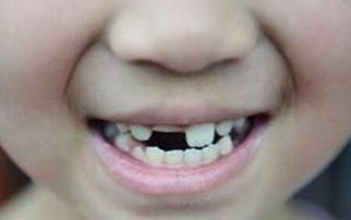 梦见牙齿上面的污垢大块脱落,梦见牙齿上都是牙垢