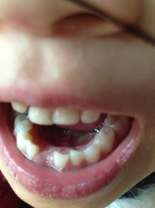 梦见落牙齿有什么预兆解梦，梦见下牙掉了几颗没出血