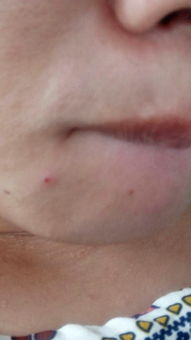 梦见挤脸上脓包并出血?，梦见脸上挤出脓