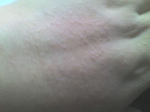 梦见手背长痘,梦见手上起痘痘